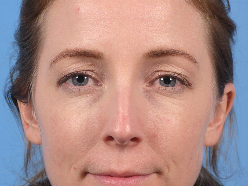 Blepharoplasty Patient 01 Before Thumbnail - 1