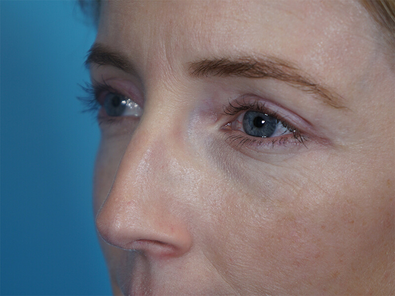 Blepharoplasty Patient 01 After Thumbnail - 2