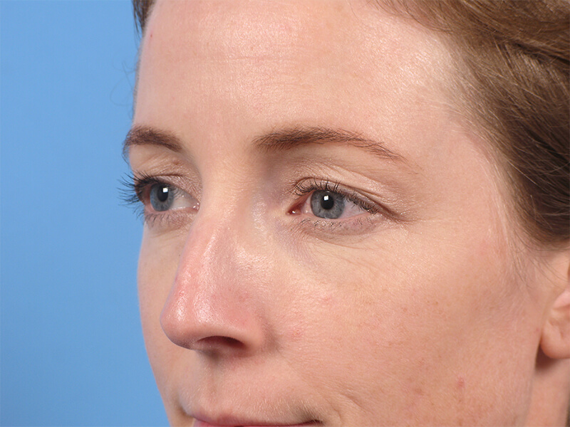 Blepharoplasty Patient 01 Before Thumbnail - 2