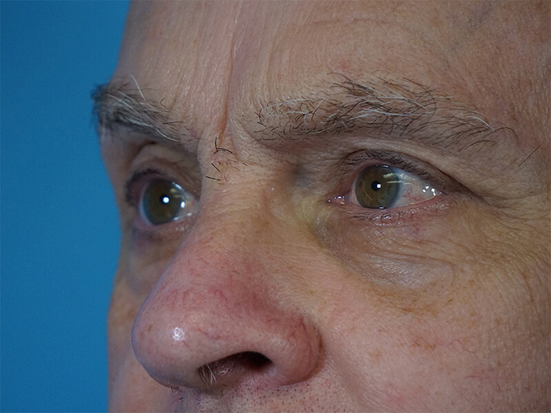 Blepharoplasty Patient 02 After Thumbnail - 2