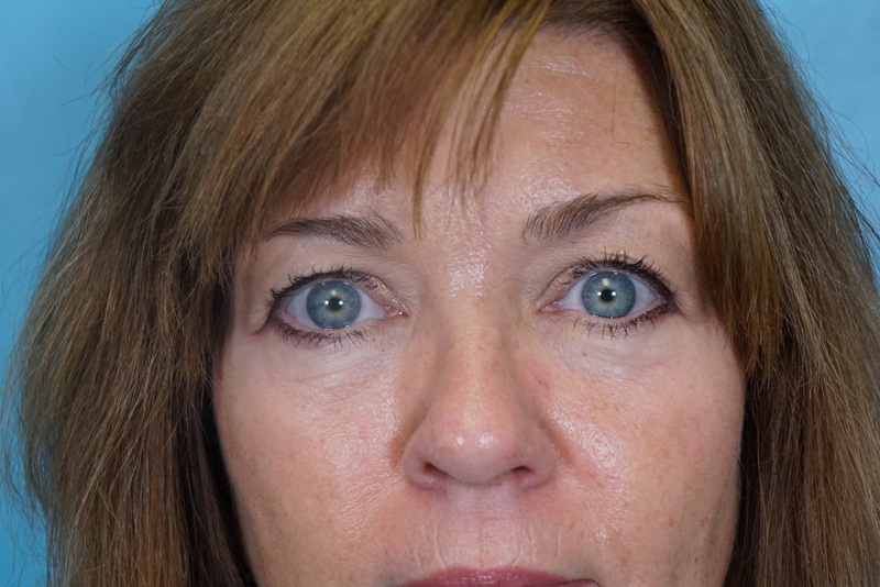 Blepharoplasty Patient 03 Before Thumbnail - 1