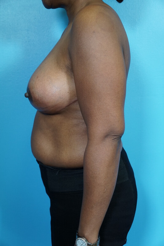 Breast Reduction Patient 01 After Thumbnail - 3