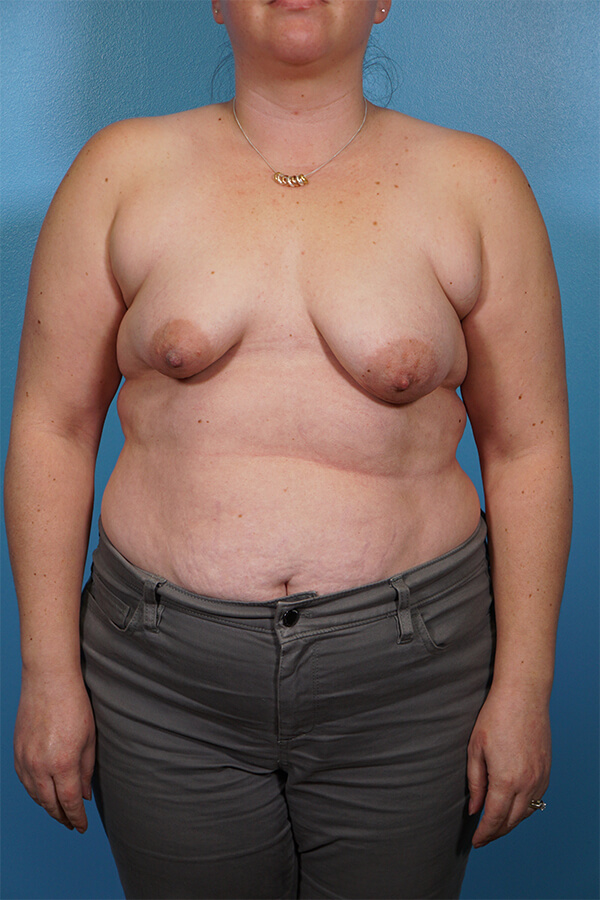 Breast Reconstruction Patient 01 Before Thumbnail - 1