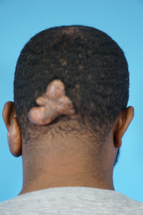 Keloid Excision Patient 01 Before Thumbnail - 1