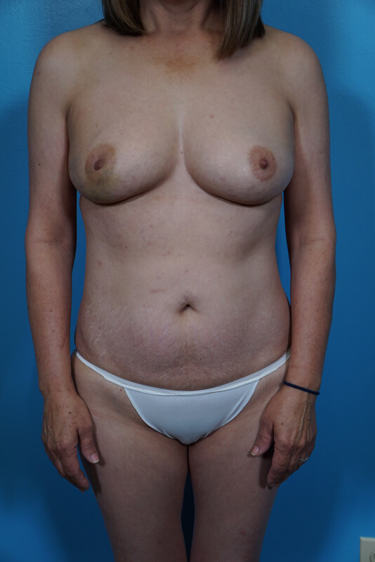 Unilateral DIEP Immediate Patient 04 Before - 1