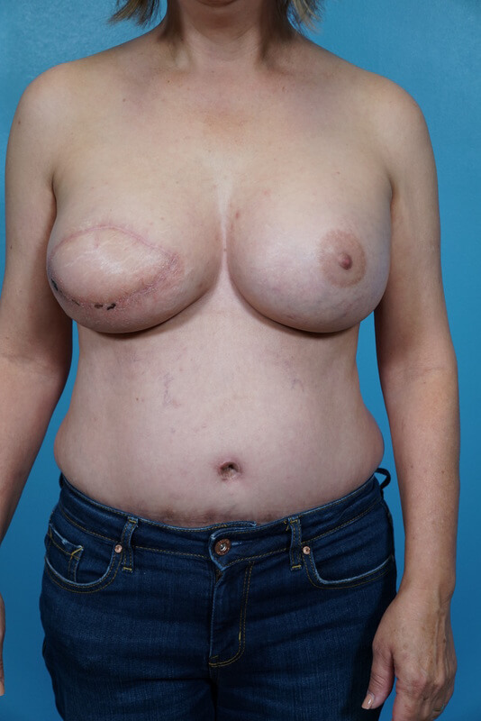 Unilateral DIEP Immediate Patient 04 After - 1